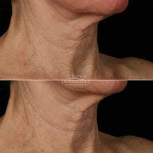 SkinMedica Neck Correct Cream, before and after 4 weeks of use, photo.